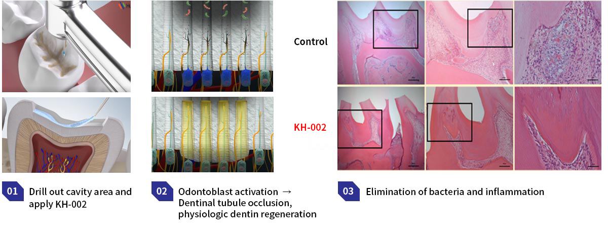 KH-001: Dental Caries Treatment